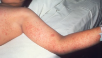 Texas measles outbreak grows to 92 cases, including 2 in Houston, most unvaccinated