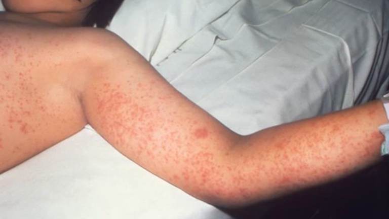 Texas measles outbreak grows to 92 cases, including 2 in Houston, most unvaccinated