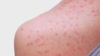 Nueces County measles vaccination rate for kindergarten-aged children above the state level