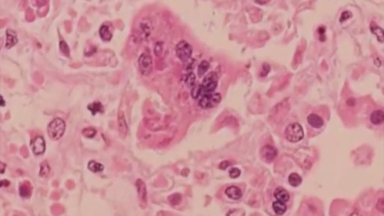 First measles death is reported in the West Texas outbreak that's infected more than 120 people