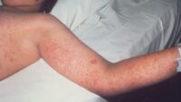 More measles cases reported in Texas: Latest data and everything we know