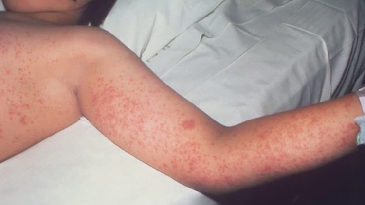 More measles cases reported in Texas: Latest data and everything we know