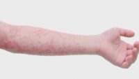 Measles cases rise in West Texas as health officials monitor outbreak