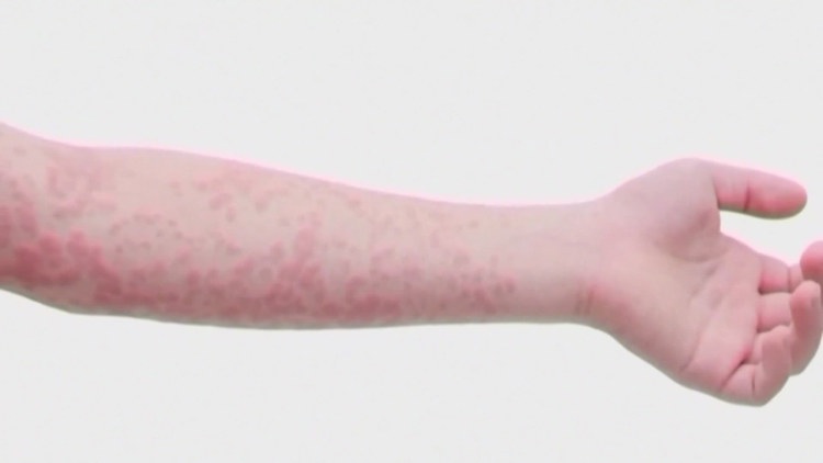 West Texas measles outbreak reached DFW, state health officials confirm