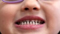 FDA and RFK Jr. aim to remove fluoride supplements used to protect kids' teeth