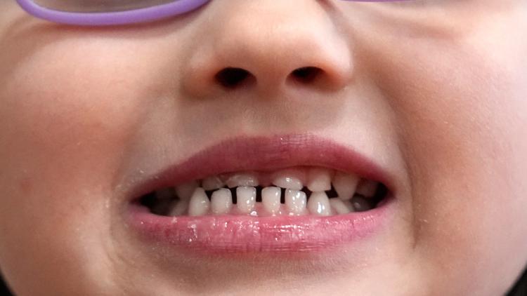 FDA and RFK Jr. aim to remove fluoride supplements used to protect kids' teeth